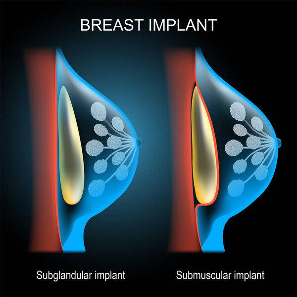 Breast implant placement comparison. 3d realistic poster. cross section of scheme of the mammary gland with implant. x-ray blue scanning. silhouette on dark background. Vector illustration
