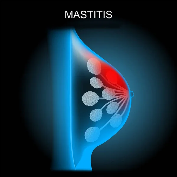 Mastit Realistisk Affisch Inflammation Bröstet Tvärsnitt Bröstkörteln Röntgenblå Skanning Ett — Stock vektor