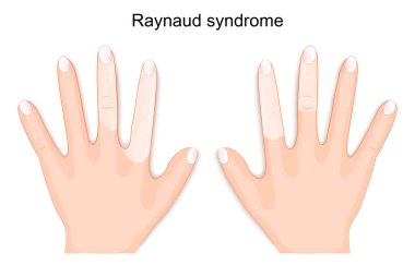 Reynaud sendromu. Saldırı sırasında Reynaud 'un fenomenine sahip birinin elleri. Vektör illüstrasyonu
