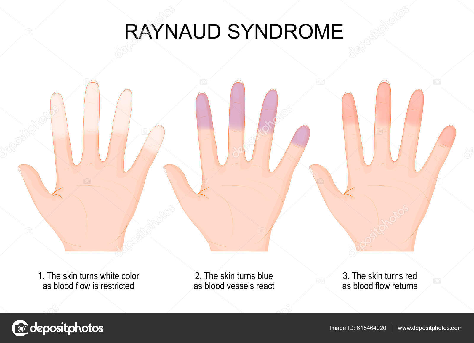 Fenómeno de Raynaud, Síndrome ou Doença de Raynaud
