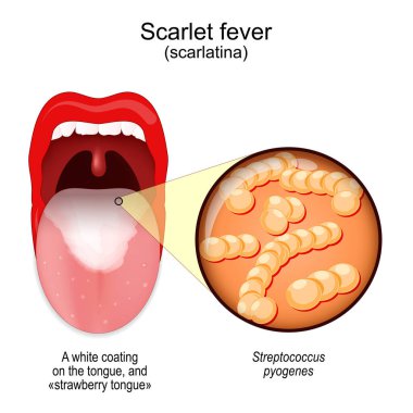 Scarlet fever. Mouth with white coating on the tongue, and strawberry tongue. Close-up of Streptococcus pyogenes. Bacteria that cause this disease. Vector poster clipart