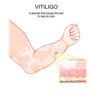 Vitiligo. Deri bozukluğu olan insan eli. Derinin rengini kaybeden kesitleri. vektör illüstrasyonu
