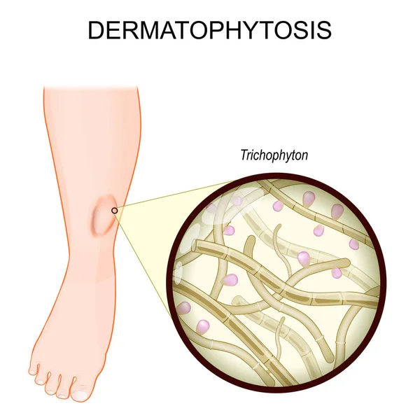 Dermatofytos Ringorm Ett Mänskligt Ben Svampinfektion Huden Närbild Trichophyton Svampar — Stock vektor