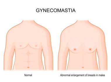 Jinekomastia. Erkeklerde normal göğüs ve anormal göğüs büyümesi arasındaki fark ve karşılaştırma. İnsan göğsü ön tarafta. Östrojenler ve androjenler arasındaki hormon dengesizliği. Vektör posteri.