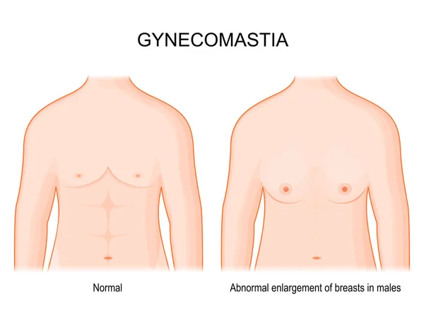 Gynecomastia Összehasonlítás Különbség Normál Mell Kóros Mellnagyobbodás Között Férfiaknál Emberi — Stock Vector