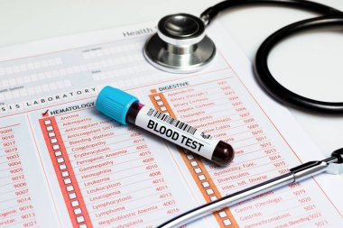 Kan örneği hematoloji laboratuvarında incelenmek üzere tüpte. Tıbbi testler için bir tüp kan.