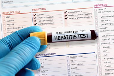 Hepatit hastalığının analizi için laboratuarda kan örneği tüpü. Hepatit testi için talep raporu içeren kan tüpü testi 