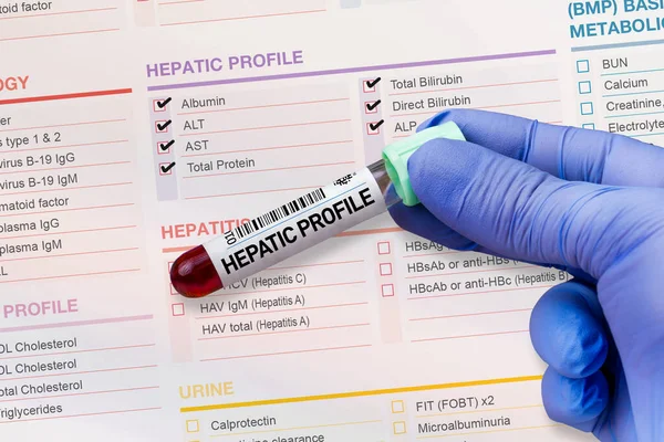 実験室での肝プロファイリングの分析のための血液サンプルチューブ 肝プロファイルのための要求フォームと血液チューブテスト — ストック写真