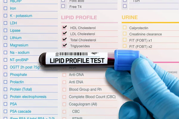 Krevní Zkumavka Pro Analýzu Lipidového Profilu Laboratoři Test Krevní Trubice — Stock fotografie