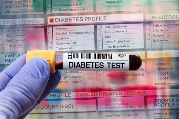 Laboratuvarda Diyabet Profil Tahlili Için Kan Örneği Tüpü Diyabet Testi — Stok fotoğraf