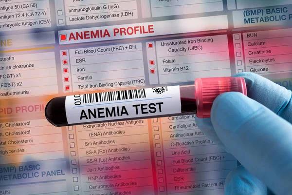Tubo Amostra Sangue Para Análise Teste Perfil Anemia Laboratório Teste — Fotografia de Stock