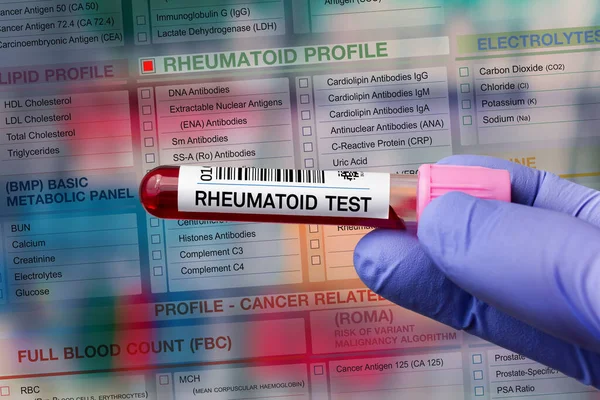 Blutprobenröhrchen Zur Analyse Des Rheumatoiden Profils Labor Blutröhrchen Test Mit — Stockfoto