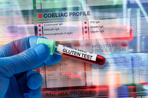 実験室でのコエリアックおよびグルテンプロファイル検査の分析のための血液サンプルチューブ Coeliacテストのための要求フォームと血液チューブテスト — ストック写真