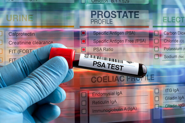 Blood sample tube for analysis of Prostate PSA profile test in laboratory. Blood tube test with requisition form for Prostate PSA test