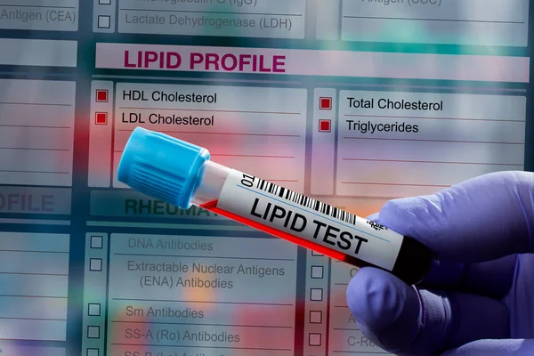 Blood Sample Tube Analysis Lipid Profile Test Laboratory Blood Tube — Stock Photo, Image