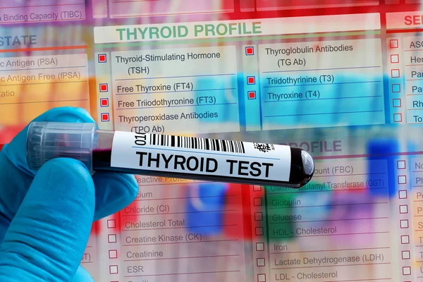 Blood Sample Tube Analysis Thyroid Hormone Profile Test Laboratory Blood — Stock Photo, Image