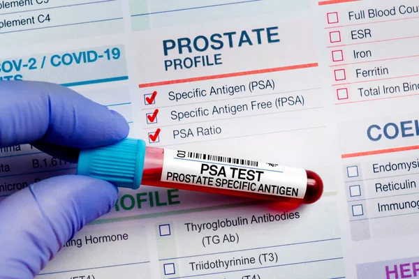 PSA Prostat Özel Antijen Profil Testi için laboratuarda kan örneği tüpü. PSA Prostat Özel Antijen Testi için talep formu içeren kan tüpü testi