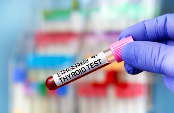 Blood Sample Tube Analysis Thyroid Gland Tests Laboratory Blood Tube — Stock Photo, Image