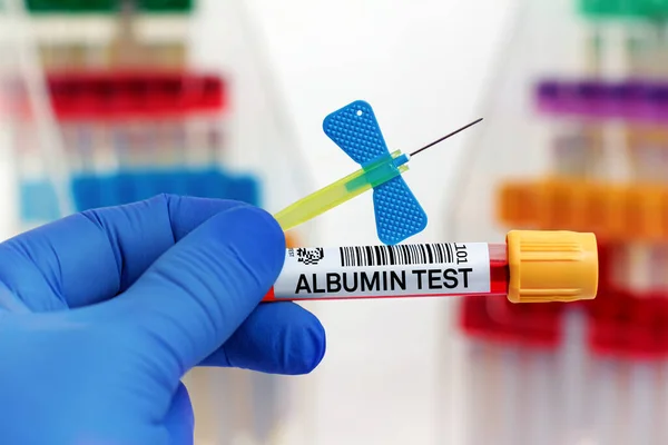 Blutprobe Des Patienten Für Albumin Test Labor Arzt Mit Blutröhrchen — Stockfoto