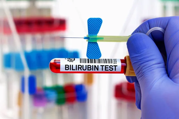 Amostra Sangue Paciente Para Teste Bilirrubina Laboratório Médico Com Tubo — Fotografia de Stock