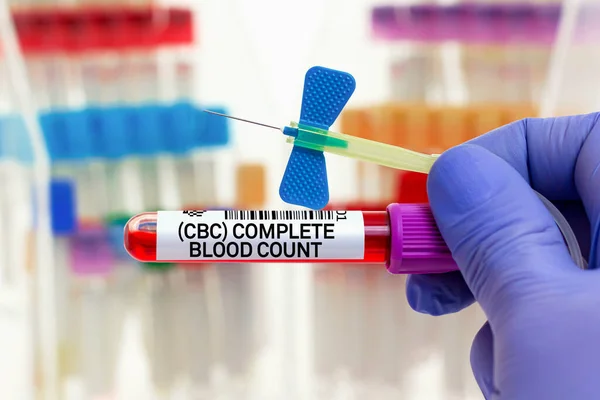 完全な血液カウントのための患者の血液サンプル研究室でCbcテスト 一般用の血液管と針を備えた医師研究室での全血数検査 — ストック写真