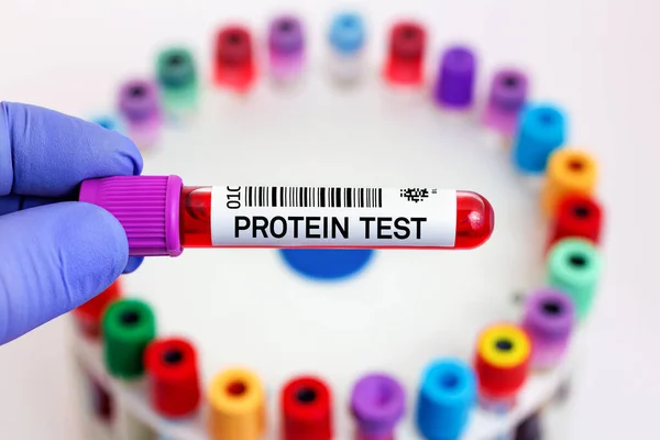 実験室でのタンパク質検査のための患者の血液サンプル 研究室でのタンパク質検査のための血液チューブ付き医師 — ストック写真