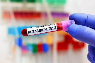 Laboratuvarda Potasyum testi için hastadan kan örneği. Potasyum testi için kan tüpü ve iğnesi olan doktor.