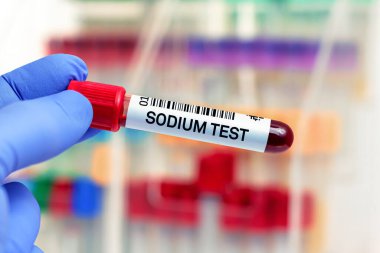 Sodyum testi için laboratuvarda hasta kanı örneği. Sodyum testi için kan tüplü doktor laboratuvarda.