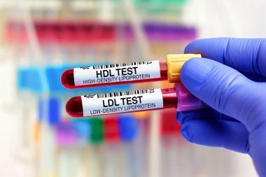 Laboratuvarda yüksek yoğunluklu Lipoprotein HDL ve düşük yoğunluklu Lipoprotein LDL testleri için kan örnekleri. HDL Yüksek Yoğunluk Lipoprotein ve LDL Düşük Yoğunluk Lipoprotein testi için kan tüpleri