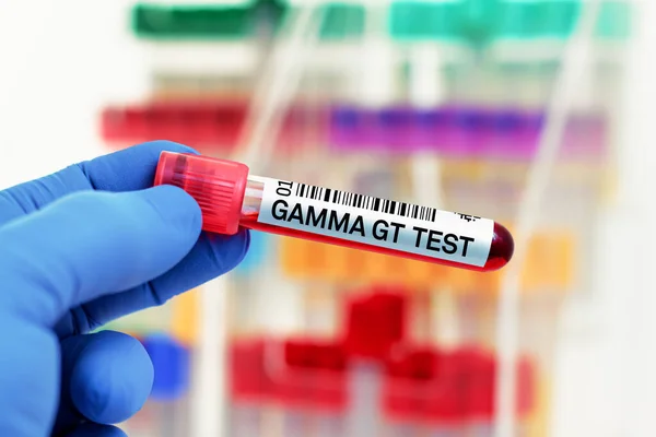 在生物化学实验室进行Gamma Ggt测试的血管医生 Gamma Ggt实验室检查病人血样分析 — 图库照片