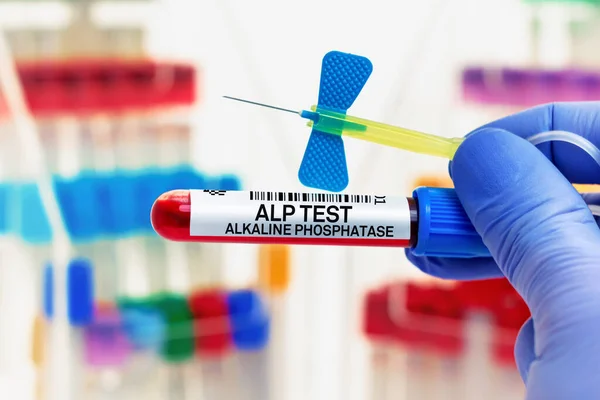 Blutprobe Des Patienten Für Alp Alkaline Phosphatase Test Labor Arzt — Stockfoto