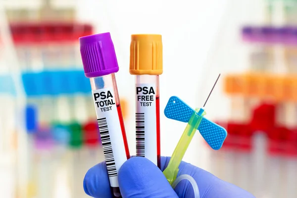 PsaフリーおよびPsaトータル検査のための患者の血液サンプル 血液チューブとPsa無料とPsaのための針を持つ医師生化学実験室での合計テスト — ストック写真