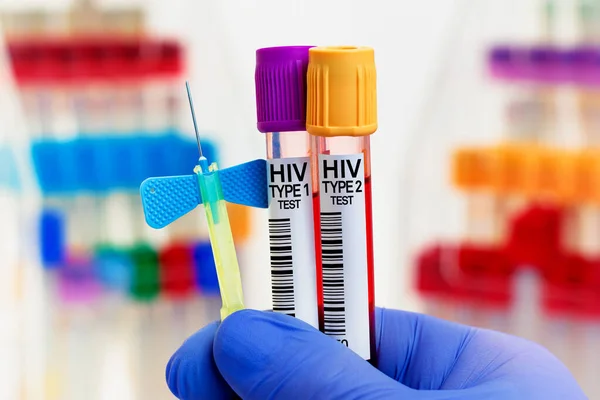 Blodprover Från Patienter För Hiv Typ Och Typ Test Laboratorium — Stockfoto