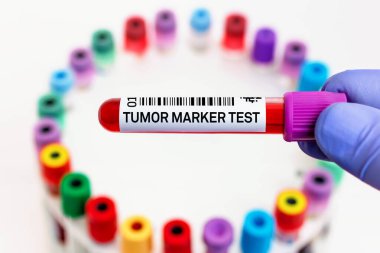 Biyokimya laboratuvarında tümör işaretleme testi için kan tüpü. Kanser biyo işaretleyicilerinin analizi için tümör işaretleyicisiyle etiketlenmiş kan tüplü doktor 