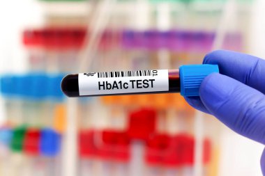 HbA1c analizi ve şeker hastası teşhisi için elinde kan tüpü tutan doktor. HbA1c veya hemoglobin A1c üzerinde çalışmak için kan örneği.