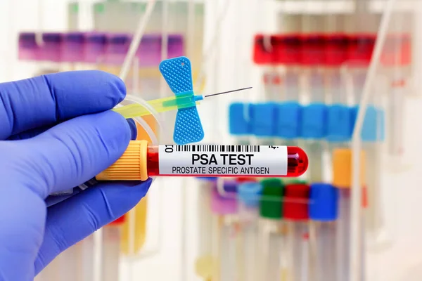 PsaフリーおよびPsaトータル検査のための患者の血液サンプル 血液管とPsa用カテーテルを備えた医師生化学研究室における前立腺特異的抗原検査 — ストック写真