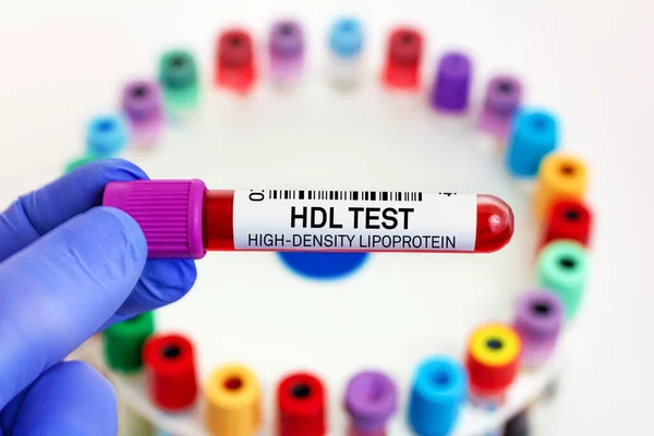 Campione Sangue Del Paziente Test Hdl Della Lipoproteina Alta Densità — Foto Stock