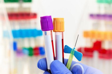 Kan bankasındaki hastalıkların teşhisi için kan örnekleriyle el teknisyeni. Kateterli doktor ve hematoloji laboratuvarında analiz için bir hastadan alınan kan örnekleriyle birlikte iki tüp.
