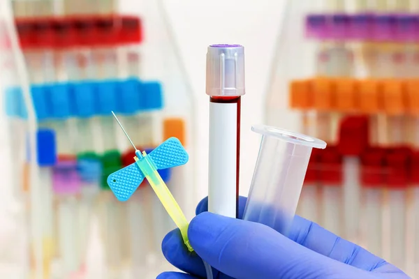 Laboratuvardaki Hastalıkların Teşhisi Için Kan Örneği Alma Seti Tutan Teknisyenlerin — Stok fotoğraf