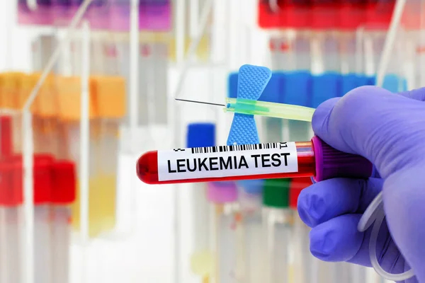 Amostra Sangue Doente Para Teste Leucemia Leucemia Laboratório Microbiologia Médico — Fotografia de Stock