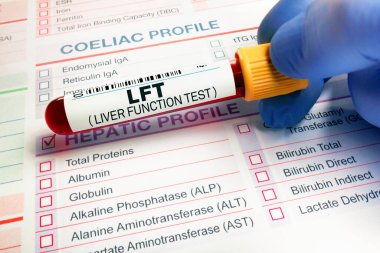 Hepatik analizi için hematoloji laboratuarındaki hastanın kan tüpü testi. Laboratuvarda LFT Karaciğer Fonksiyon Testi için kan örneği talep formu üzerinde