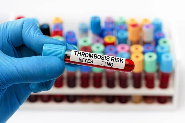 Doktorun Elinde Yüksek Riskli Trombüs Için Kan Tüpü Analizi Var — Stok fotoğraf