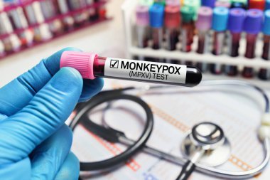 Maymun çiçeği virüsü (MPXV) bulaşmış kan testi tüpü tutan araştırmacı. Maymun Çiçeği (MPXV) hastalığı teşhisi konan tüpte kan örneği olan bir doktor.