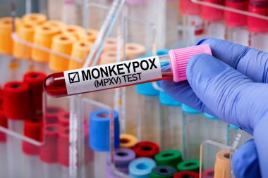 Zoonotik virüs MPXV Maymun Çiçeği Hastalığı teşhisi konan tüpte kan testi yapılan bir doktor. Maymun çiçeği virüsü (MPXV) bulaşmış kan testi tüpü tutan araştırmacı)
