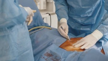 Ameliyathanede. Ameliyat masasında yatan bir hastaya ameliyat yapan bir grup doktor. Gerçek cerrahi, karın kesiği, cerrahi laparoskopi aletleri. Jinekoloji.