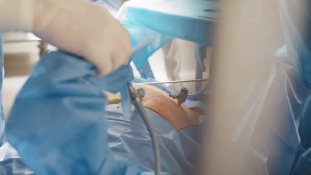 Fechar as mãos da equipe de cirurgiões durante a operação remoção do útero com instrumentos cirúrgicos de laparoscopia. Ginecologia. Cirurgião da equipa a trabalhar na laparoscopia que opera no hospital. Fechar — Vídeo de Stock