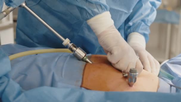 En el quirófano, el médico hace una laparoscopia. Endoscopia. Primer plano. Cirujanos manos con la ayuda de equipos e instrumentos endoscópicos realizar la cirugía de un hombre gordo o una mujer embarazada. — Vídeo de stock