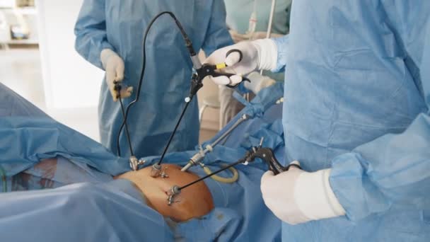 Endoscopia. Primer plano. Los cirujanos manos con la ayuda de equipos e instrumentos endoscópicos realizan la cirugía de un hombre gordo o una mujer embarazada. En el quirófano, el médico hace una laparoscopia. — Vídeo de stock