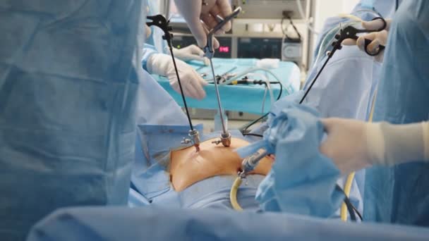 Cierre de manos del equipo de cirujanos durante la operación extirpación del útero con instrumentos de laparoscopia quirúrgica. Manos de un equipo de cirujanos de cerca en el quirófano durante la operación, instrumentos — Vídeo de stock