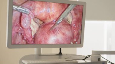 Laparoskopik ekipman kullanılarak ameliyat işlemi. Ameliyat ekipmanlarıyla ameliyathane. Tıbbi geçmişi var. Süreci ekrandan izliyorum. Tıbbi robot. Robot Cerrahi.